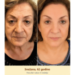 Pčelinji otrov serum primena na licu žene